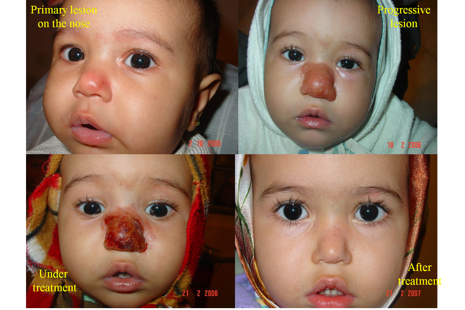 Cutaneous leishmaniasis caused by leishmania tropica in Bam
