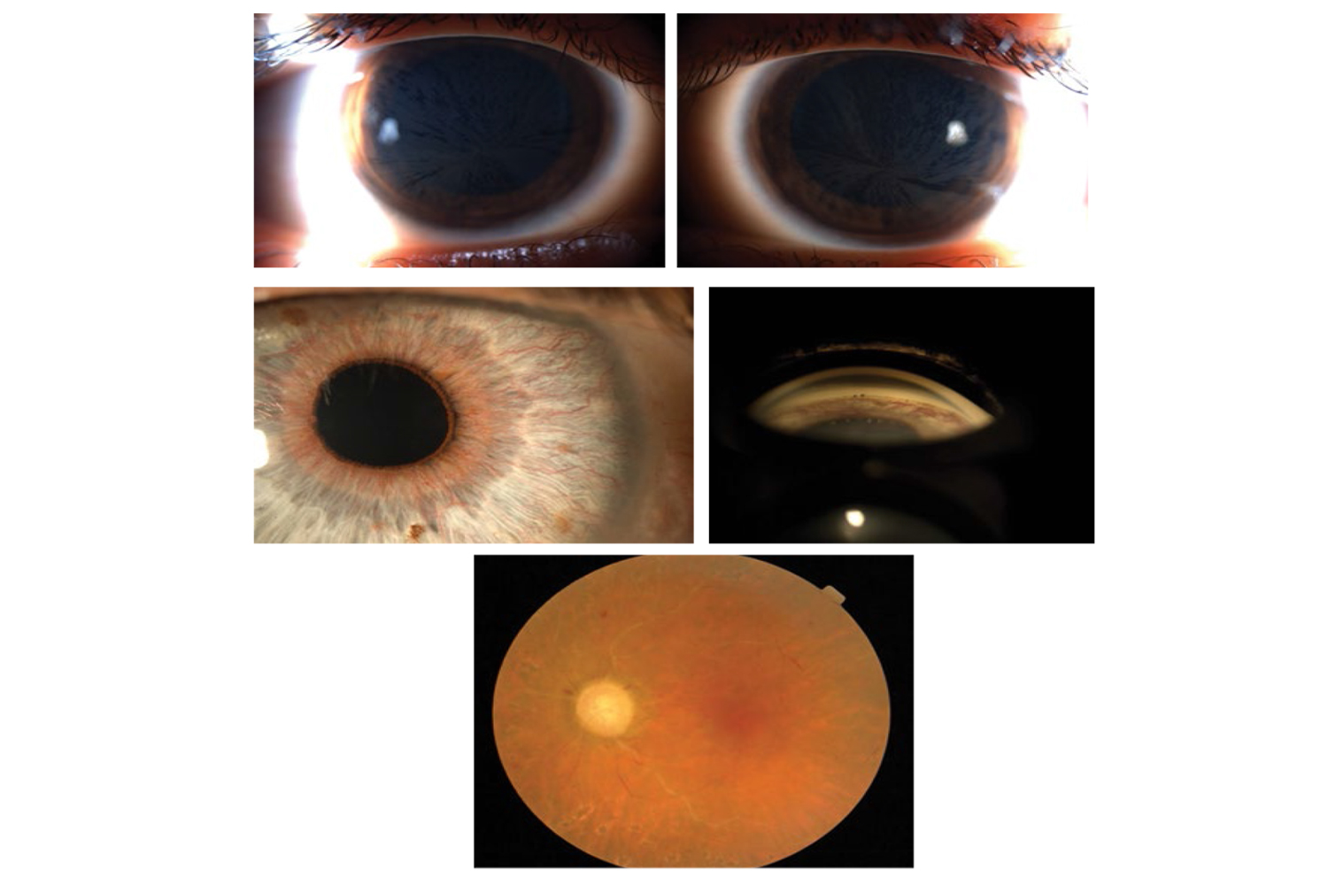 Cornea Verticillata and Obstruccion Carotid Artery