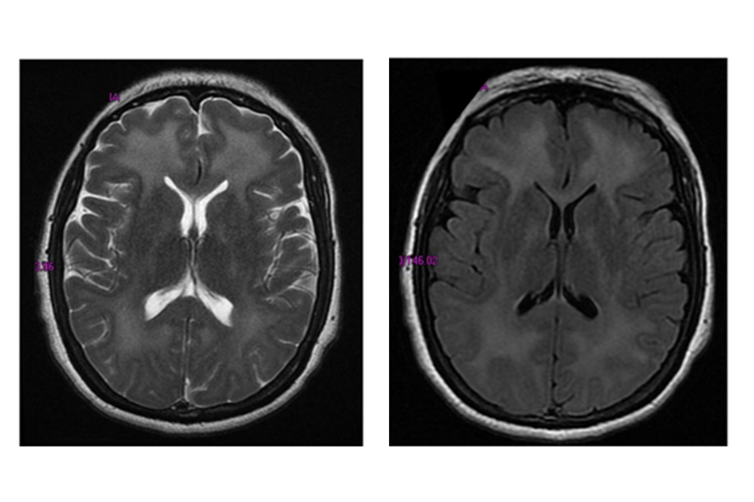 Magnetic Resonance Imaging Of The Brain In Methane Gas Intoxication