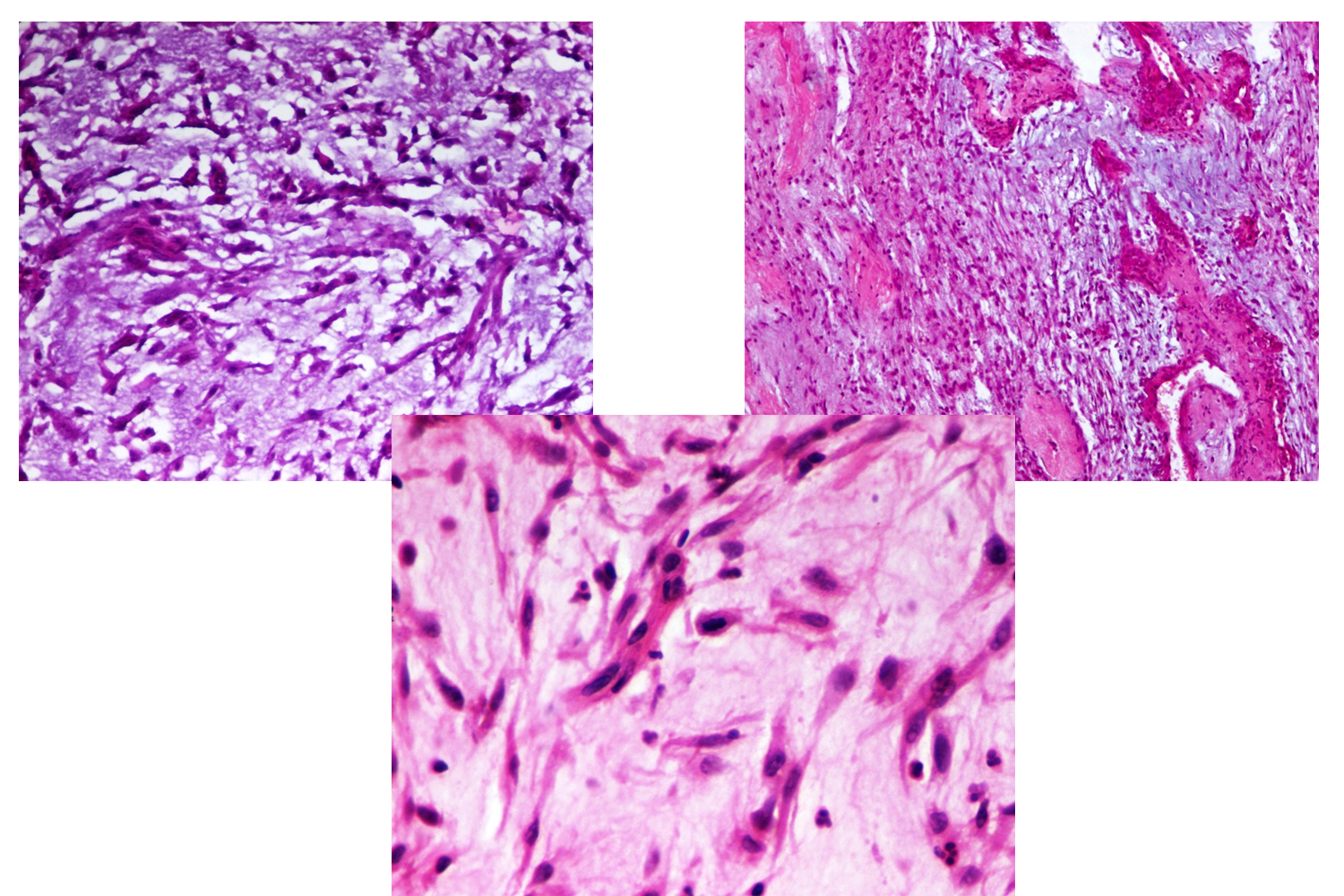 Myxoid Leiomyosarcoma of the Uterus