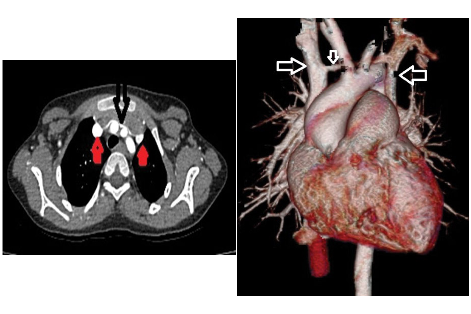 Double Superior Vena Cava