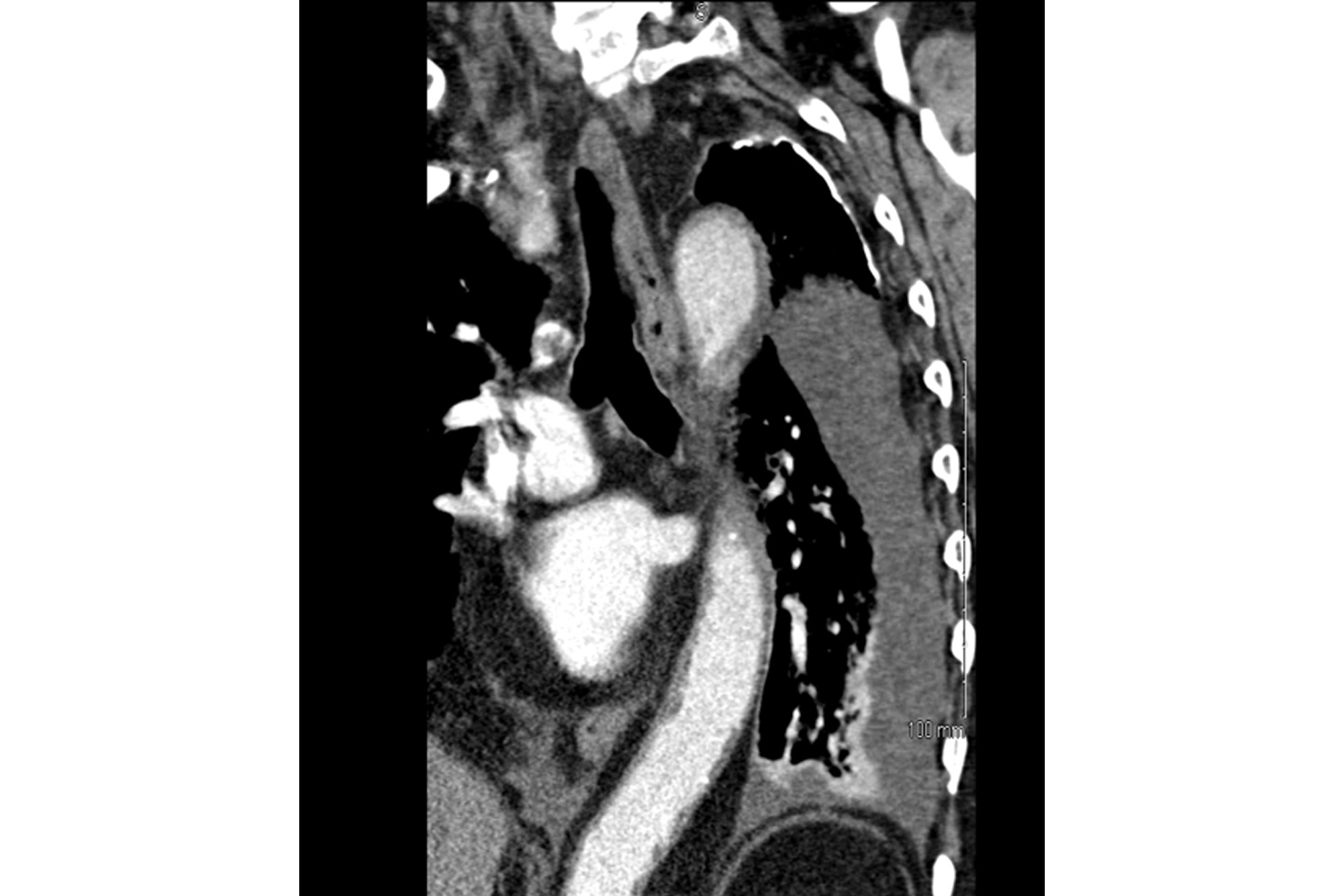 Incidental Finding of Mesothelioma after a Motor Vehicle Accident