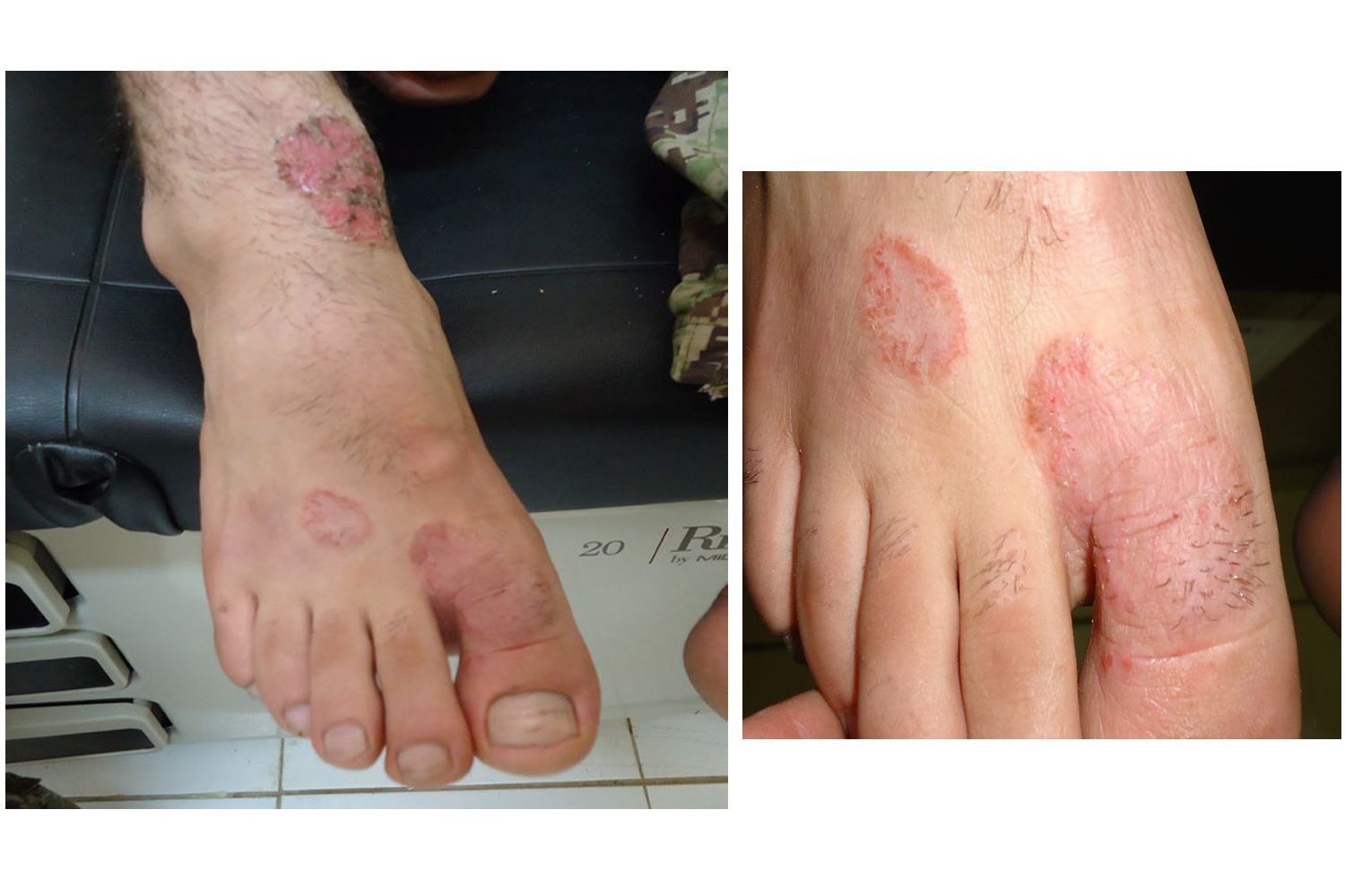 Tinea Pedis