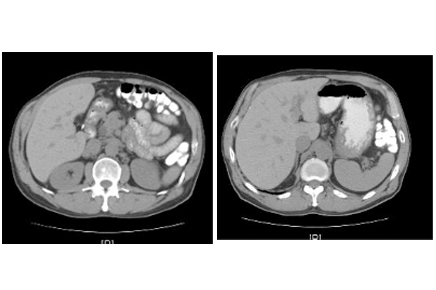 Hereditary Hemochromatosis and Hyperdense Liver by CT Scan