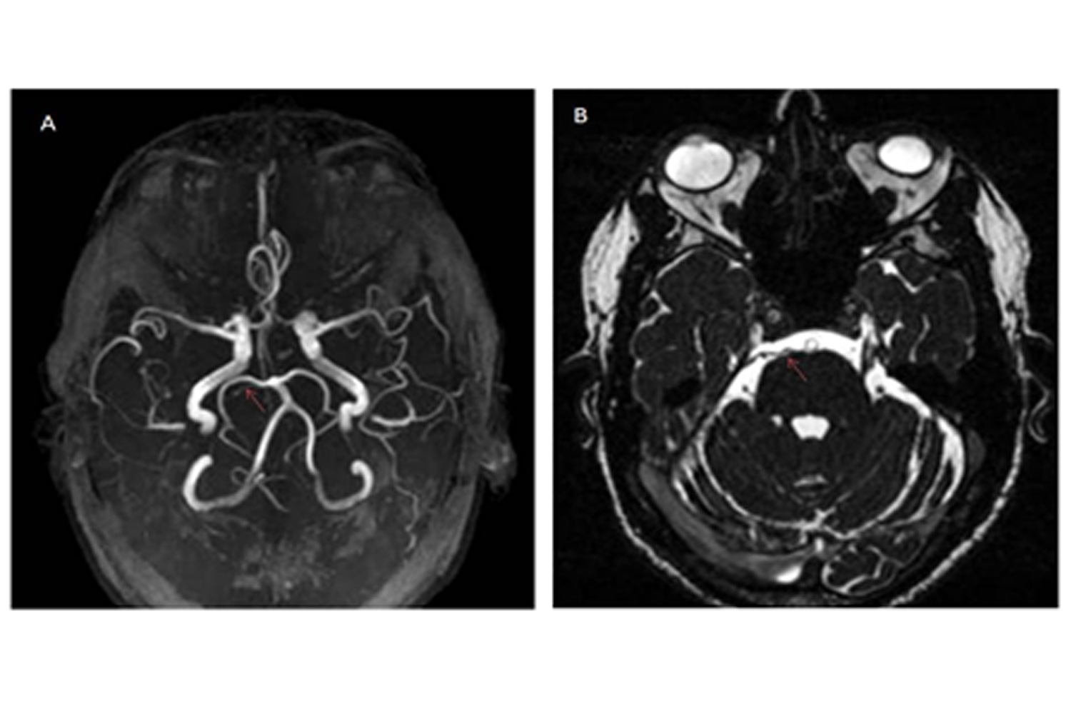 Superior Cerebellar Artery Compressing the Trigeminal Nerve