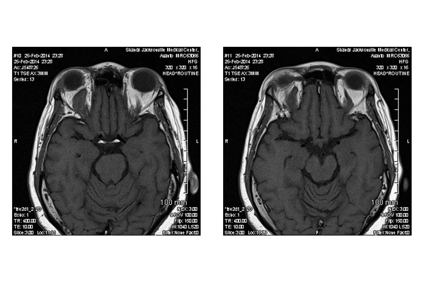 Undiagnosed Stage 4 Lupus Nephritis presenting as Right eye blindness from Superior Ophthalmic Vein Thrombosis