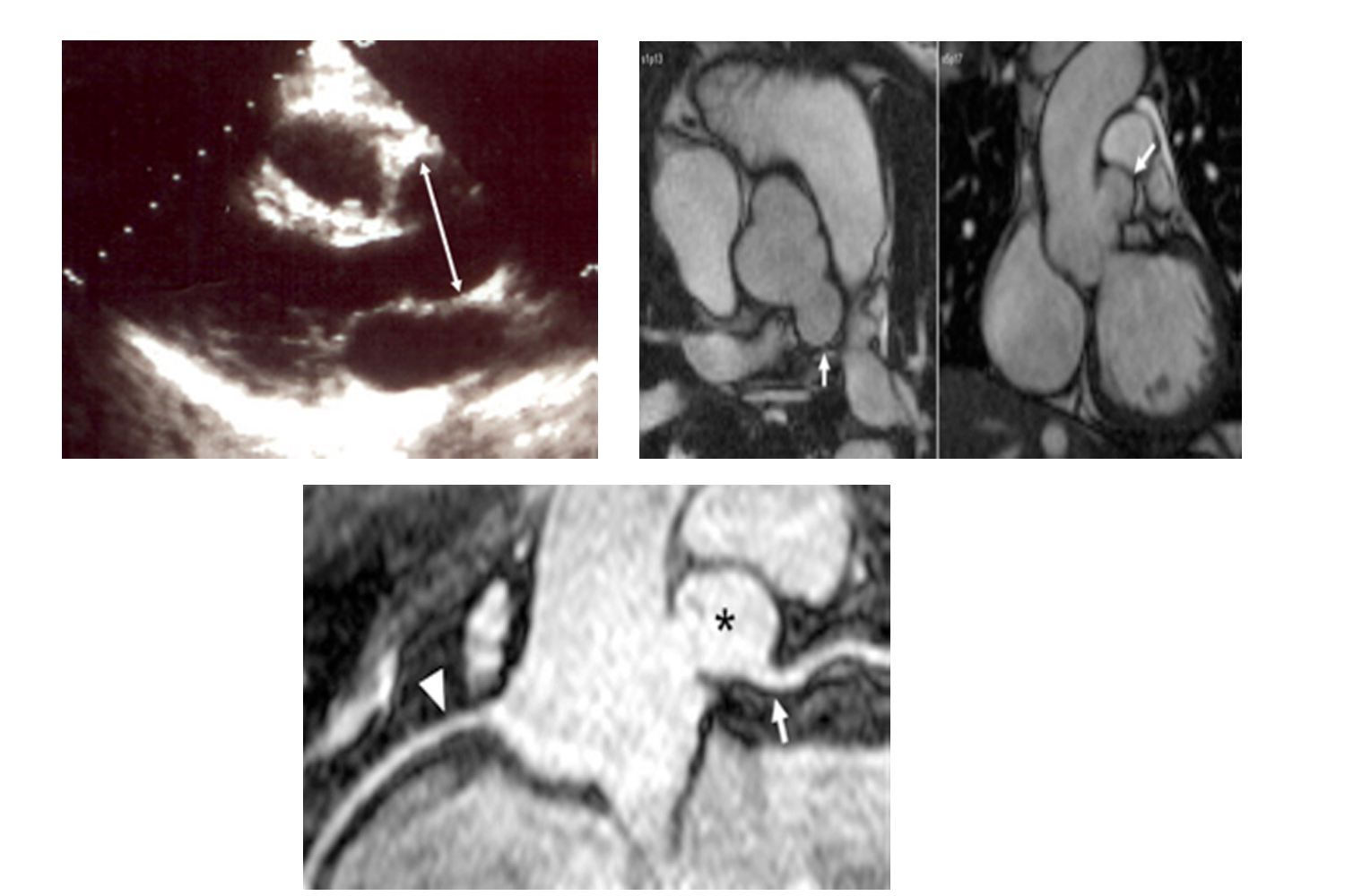 Sinus of Valsalva Aneurysm by Magnetic Resonance Imaging