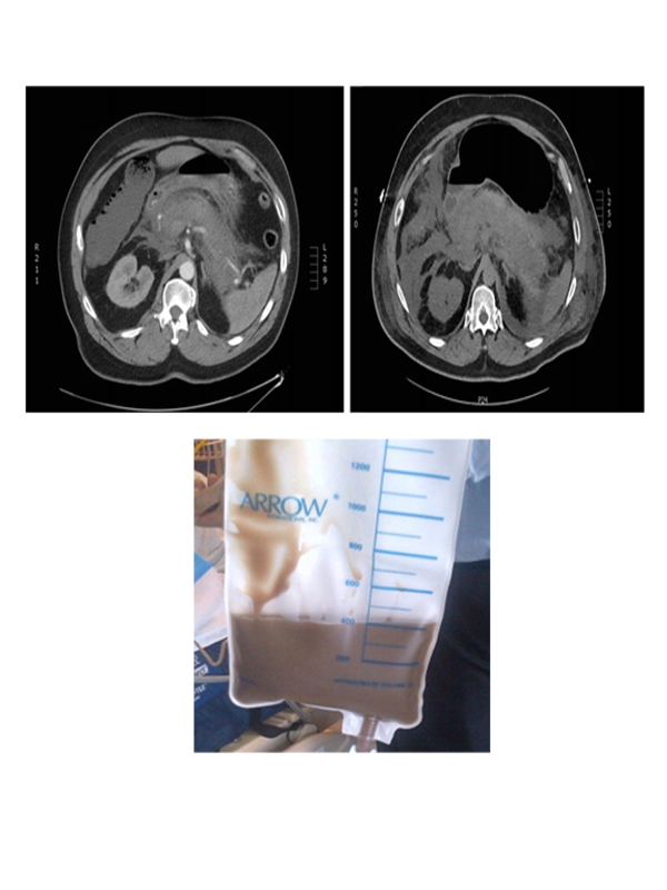 Am I Aspirating Ascites or Feces? An Interesting Case of Pancreatitis Caused By Mild Hypertriglyceridemia