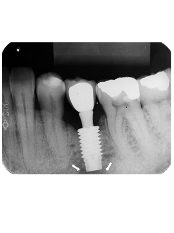 Auxiliary Method for the Diagnosis of the Implant Periapical Lesion