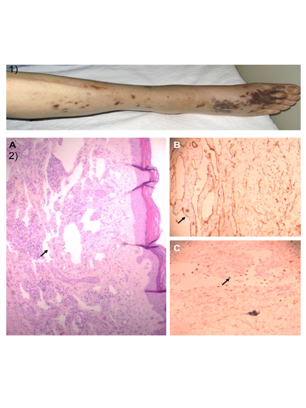 Kaposi’s sarcoma in a frail elderly