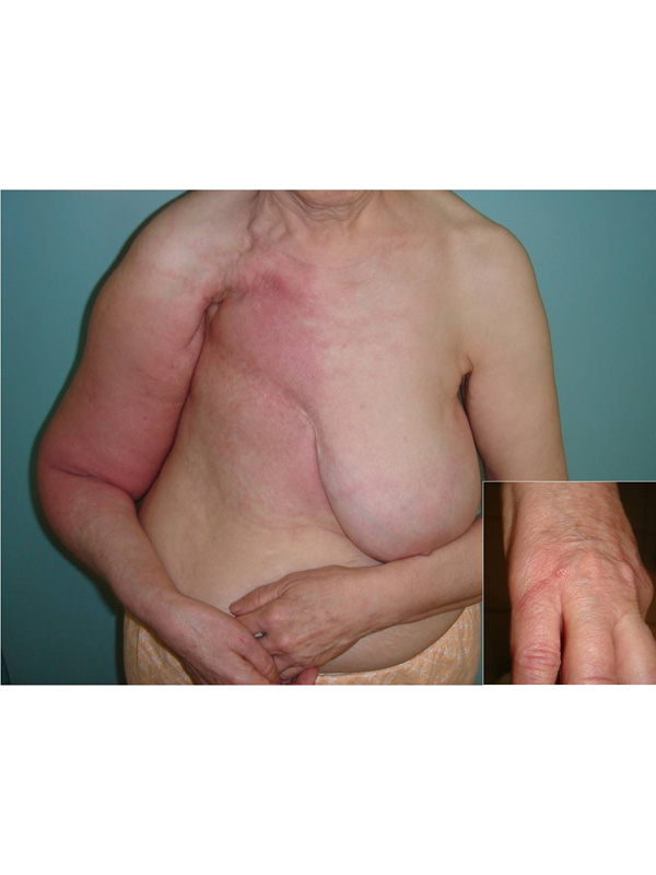 Lymphangitis due to Insect Sting after Radical Mastectomy