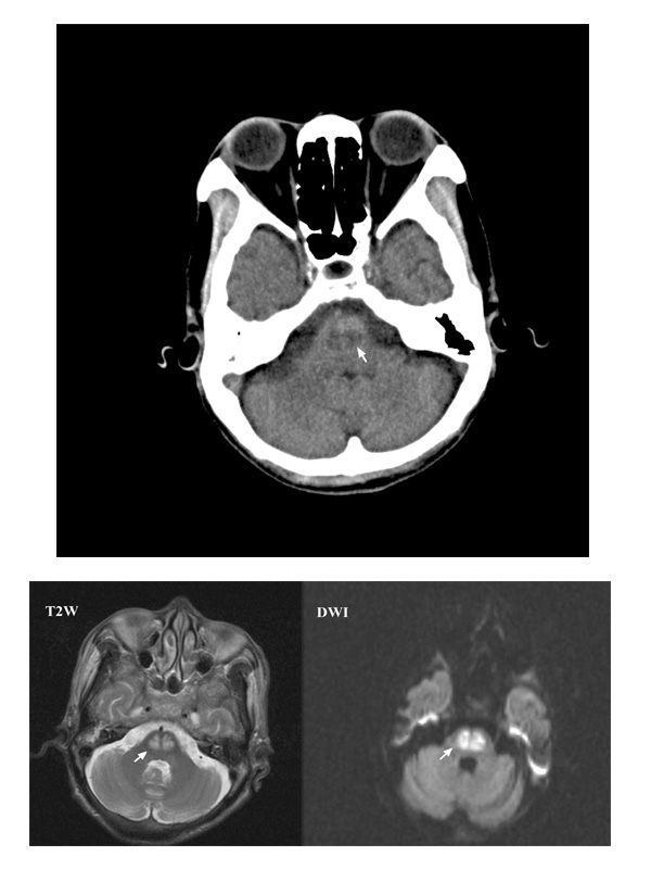 Rare Association of Central Pontine Myelinolysis with Diabetic Hyperglycemia: CPM Associated with Hyperglycemia