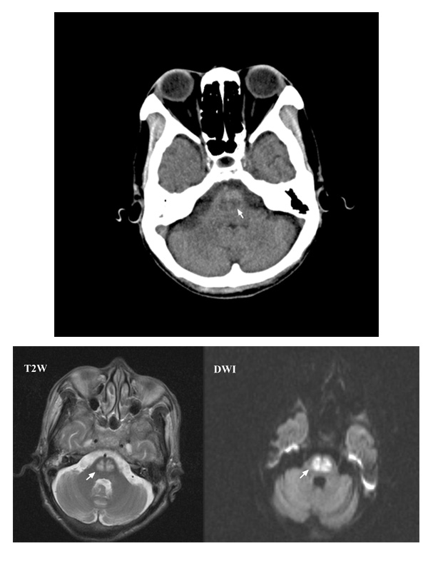 A Patent Foramen Ovale Saves the Day in a Rare Case of Right Ventricular Outflow Tract Obstruction