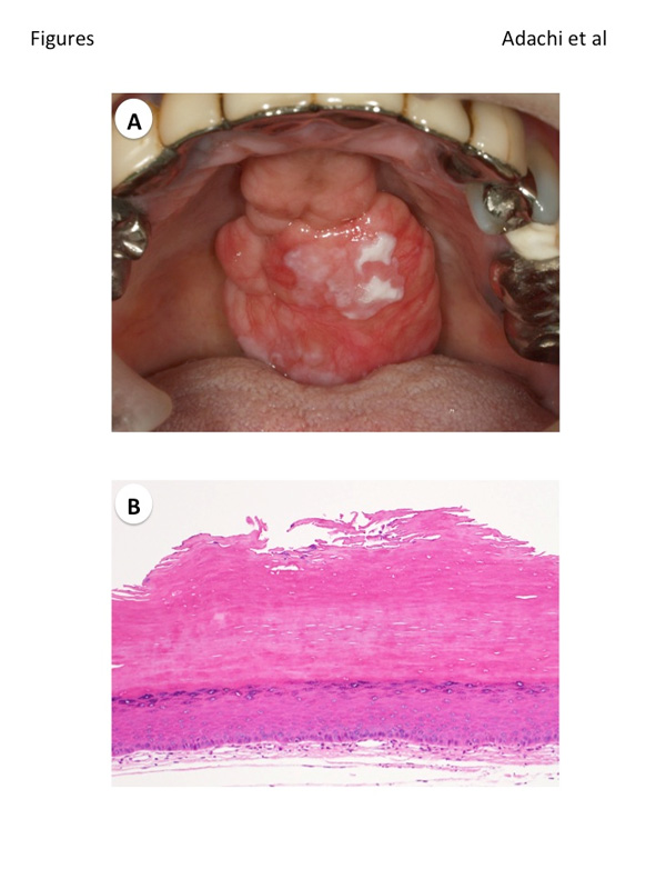 Leukoplakia on Torus Palatinus