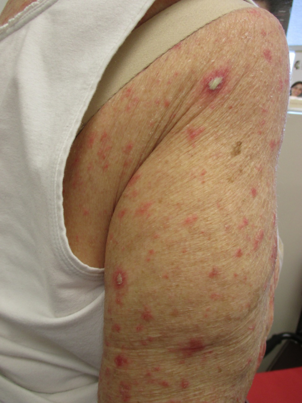 Acute Generalized Exanthematous Pustulosis