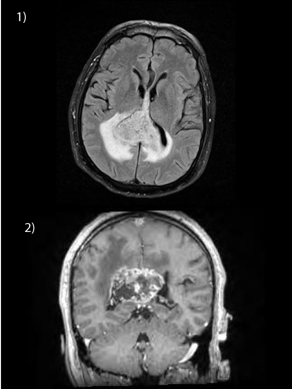 Butterfly Glioma Involving Splenium of Corpus Callosum