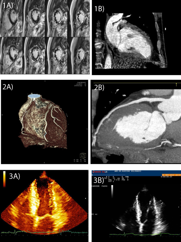 Apical Left Ventricular Akinesis in Middle-Aged Endurance Athlete: A Clinical Dilemma