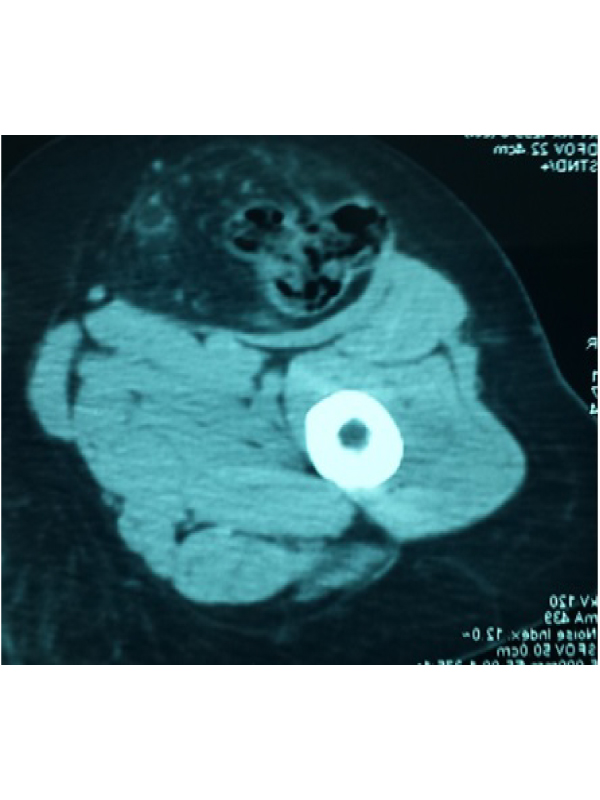 Femoral Hernia Invading the Right Thigh