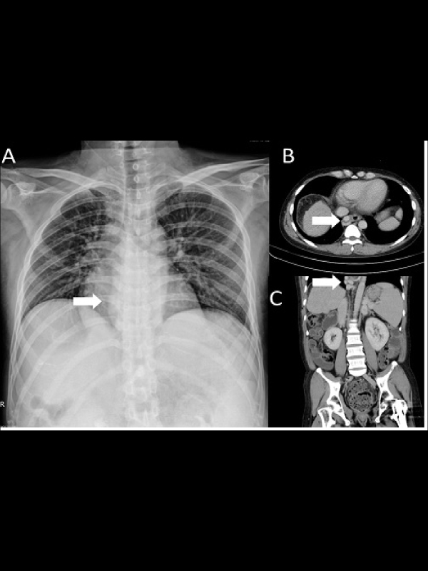 A Retrocardiac Opacity in a Cirrhotic Patient - Esophageal Varices
