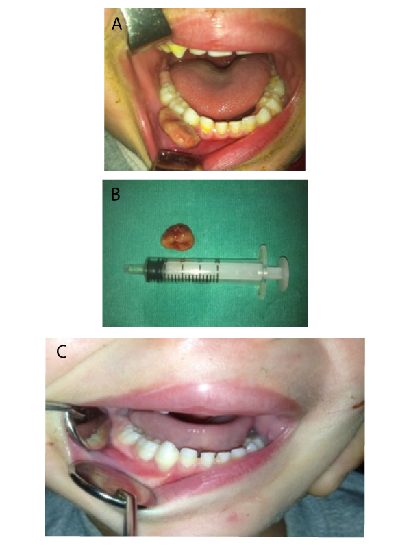 Peripheral Giant Cell Granuloma (PGCG) in a Pediatric Patient: A Case Report