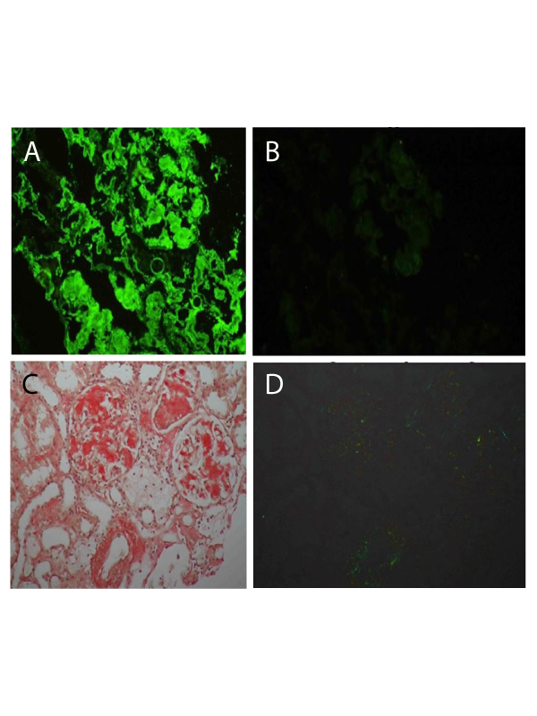 A Case of AL Amyloidosis