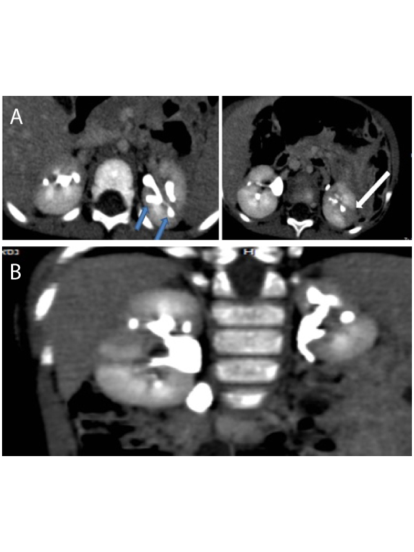 CT Signs of Intrarenal Reflux