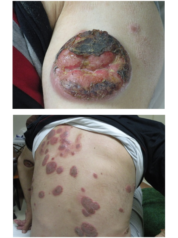 Primary Cutaneous Anaplastic Large Cell Lymphoma