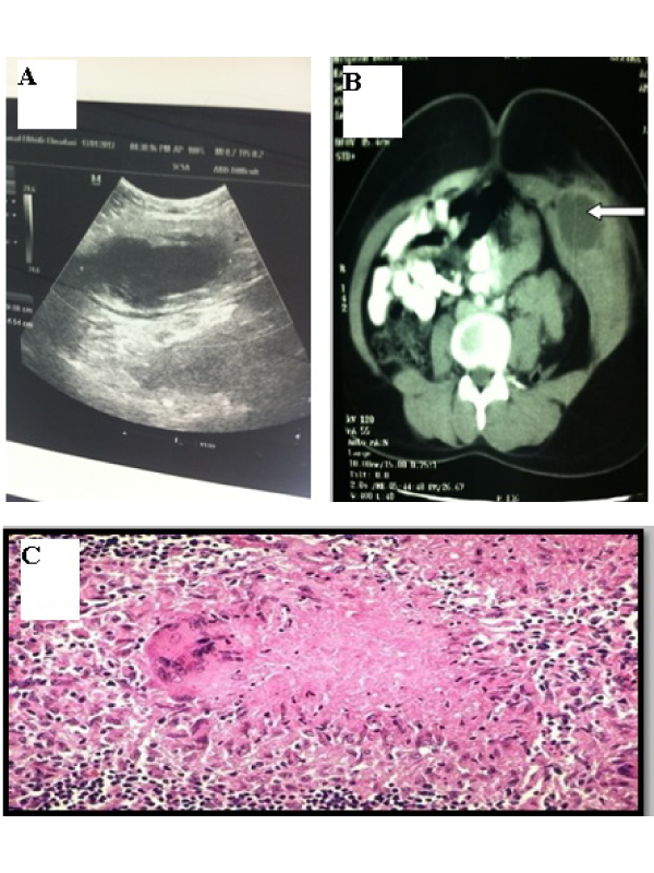 Primary Cold Abscess of Rectus Abdominis Muscle