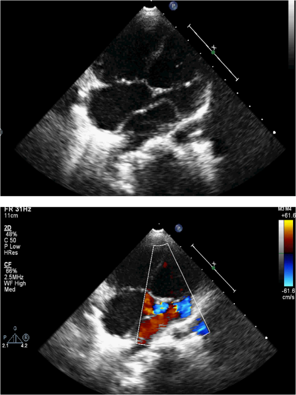 Rare Case of Triatrial Heart with Unroofed Coronary Sinus