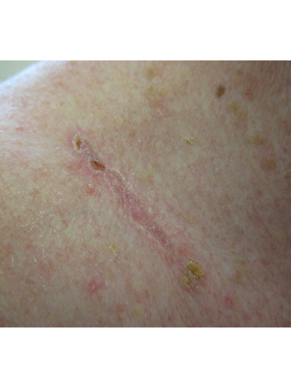 Sclerosing Basal Cell Carcinoma