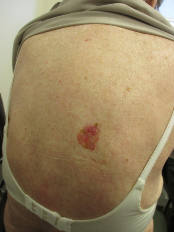 Superficial Basal Cell Carcinoma