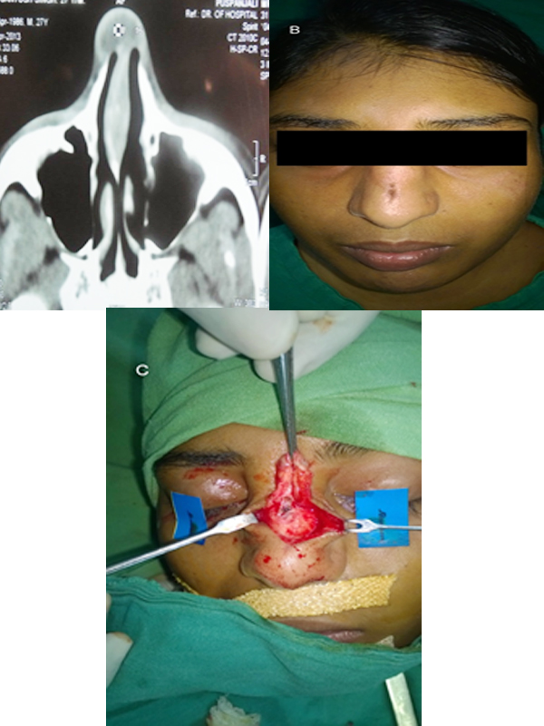 A Case of Midline Nasal Dermoid