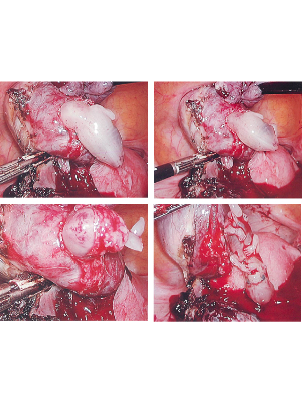 Spontaneous Expulsion of Ruptured Ectopic Pregnancy