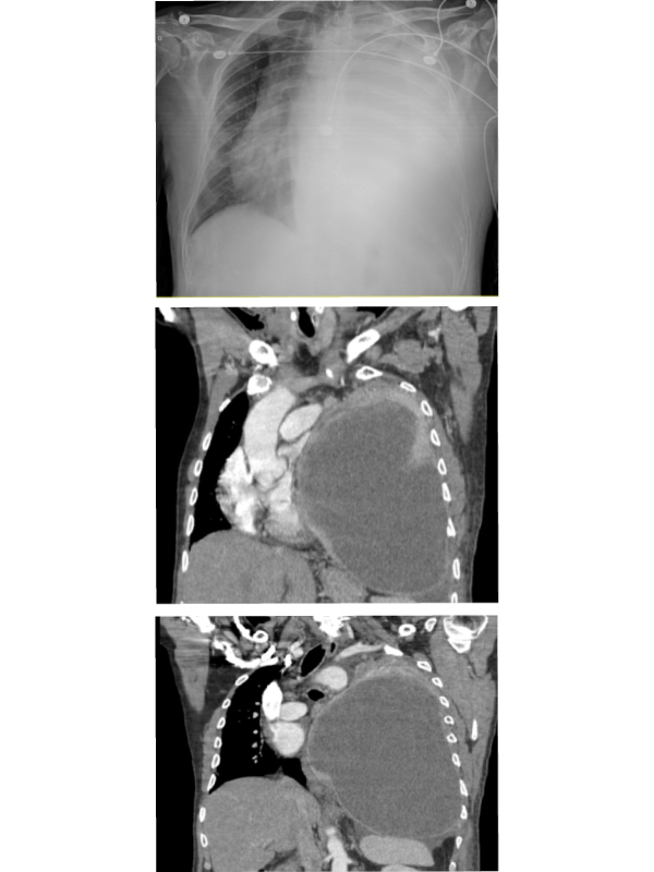 Cytic Presentation of Lung Adenocarcinoma: A Rare Entity