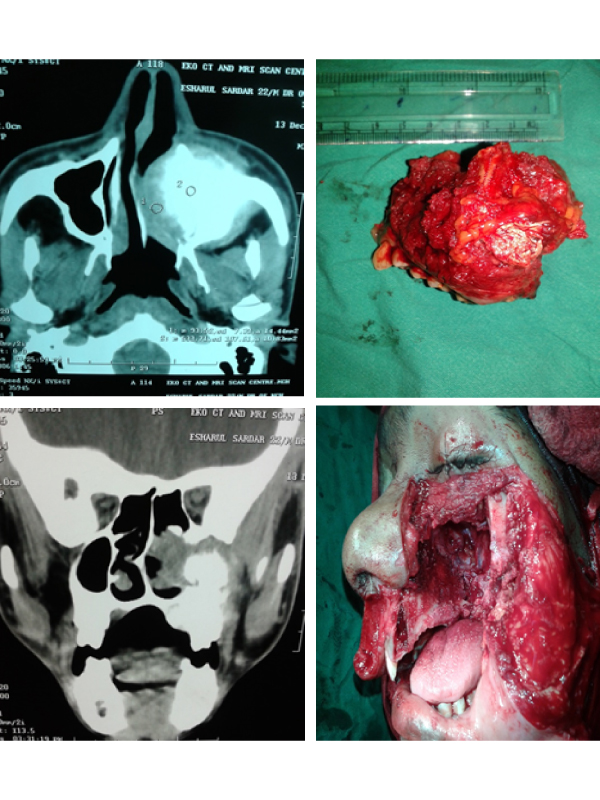 Maxillary Osteosarcoma with Fibrous Dysplasia of Frontal Bone - A Rare Case Blog