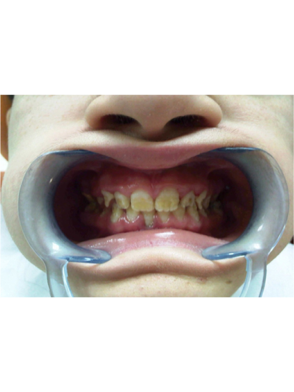 Dental Findings Associated with Hypoparathyroidism