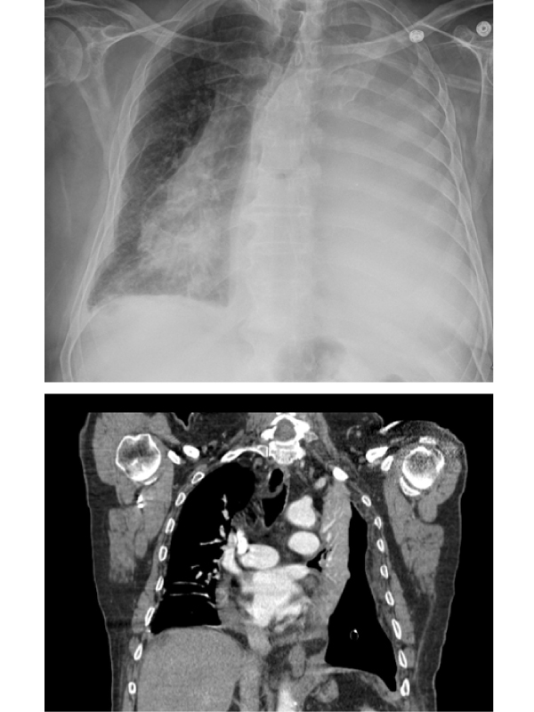 A Case of Lung Entrapment; Mesothelioma