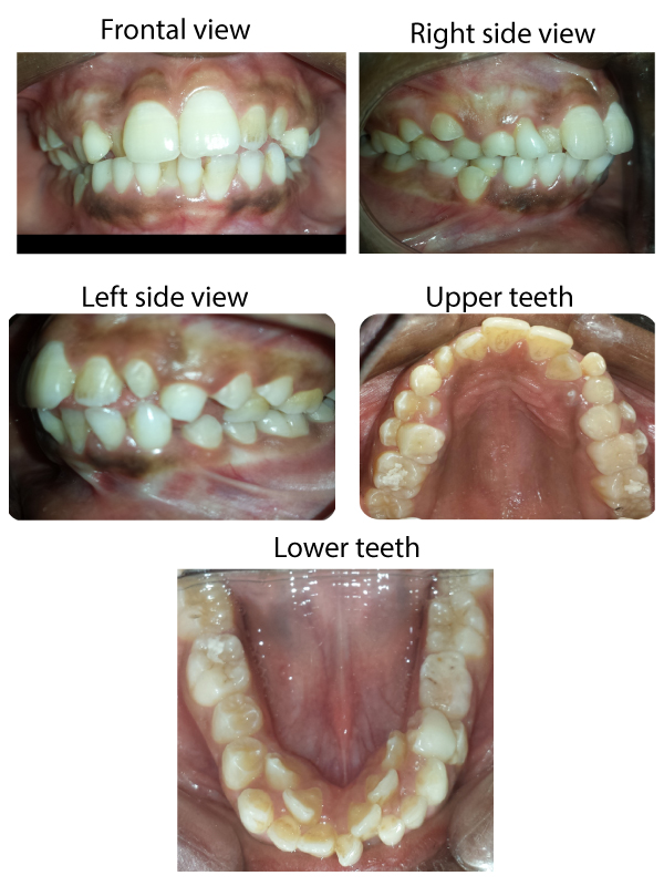 Retain Deciduous Teeth