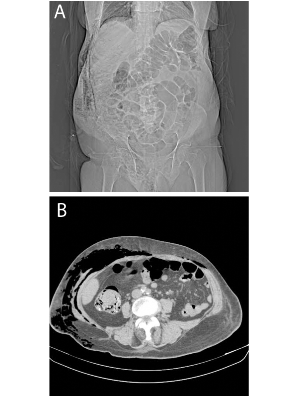 Abdominal Wall Necrotizing Fasciitis - A Hidden Presentation