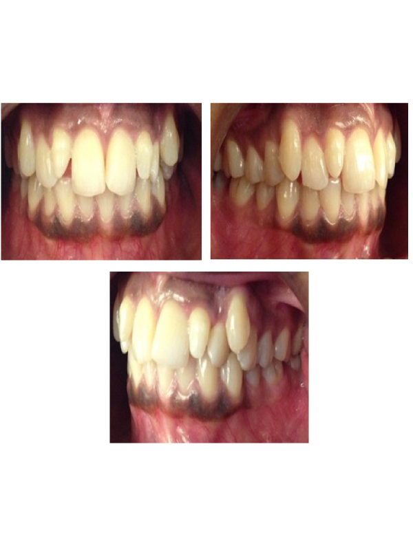 Bilateral Symmetrical Supernumerary Teeth