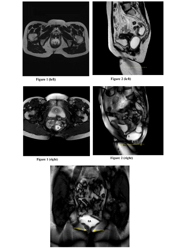 Overt Mismatch between Clinical and Imaging Findings in Pelvic Organ Prolapse (POP): Case Blog