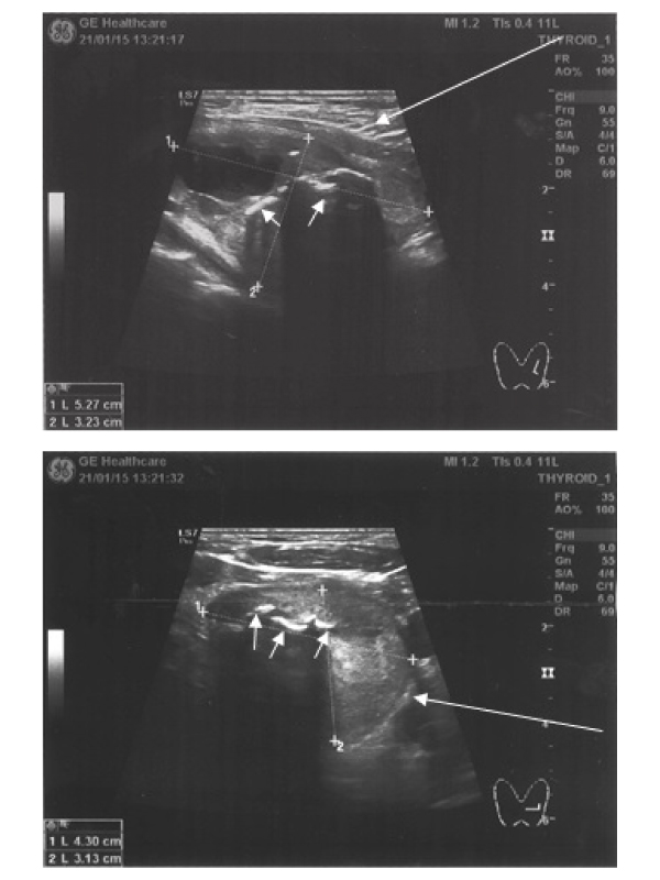 Metallic Wires-like Thyroid Calcifications