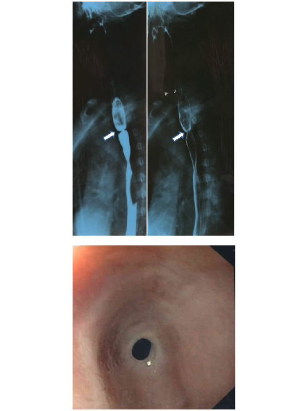 Esophageal Web in a Child
