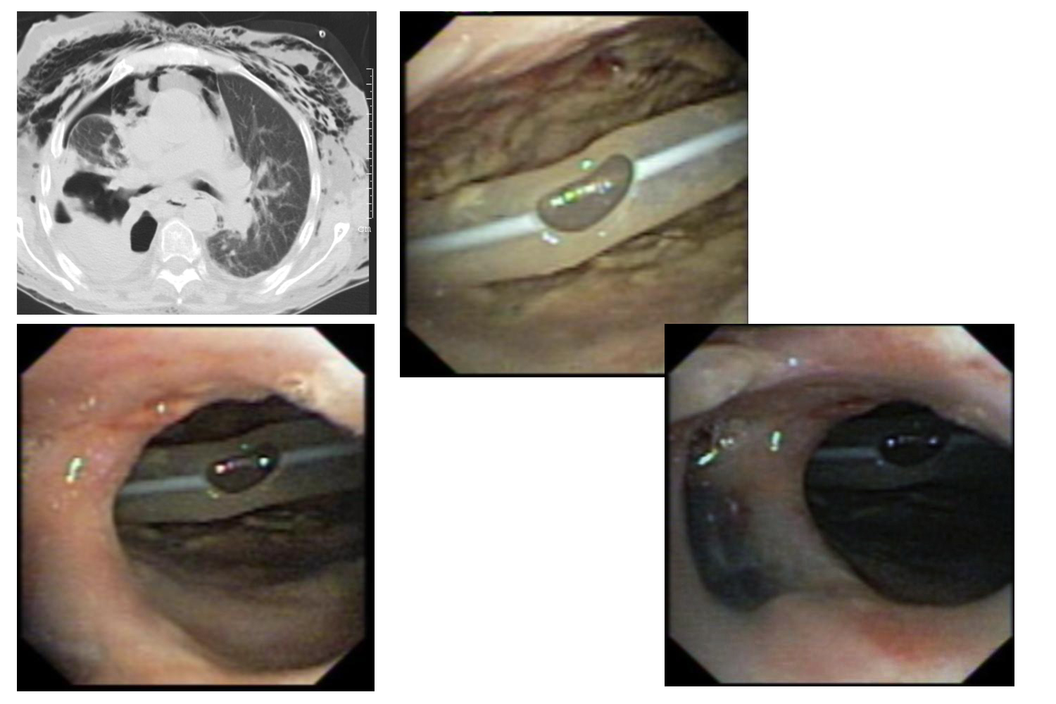 Rheumatoid Arthritis under Corticosteroid Therapy