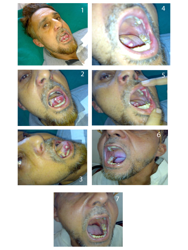 Behcet Disease