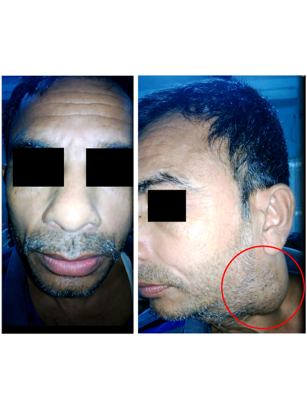 Schwannoma of the Para Pharyngeal Space