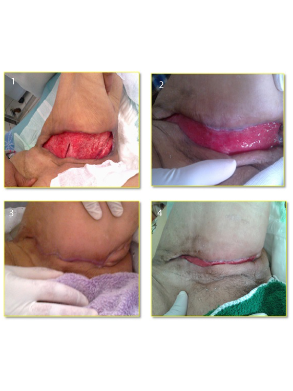 Matrix Therapy by Regenerating Agents (RGTA) in a Diabetic Patient with Necrotizing Fasciiti