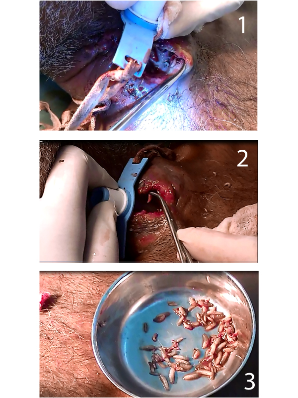 Management of Tracheostomy Site Myiasis