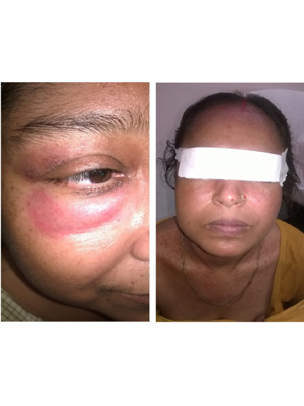 Skin Rashes in Systemic Lupus Erythematosus