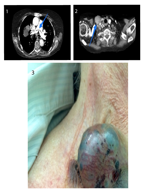 Lymph-node Metastasis in Advanced Papillary Thyroid Cancer